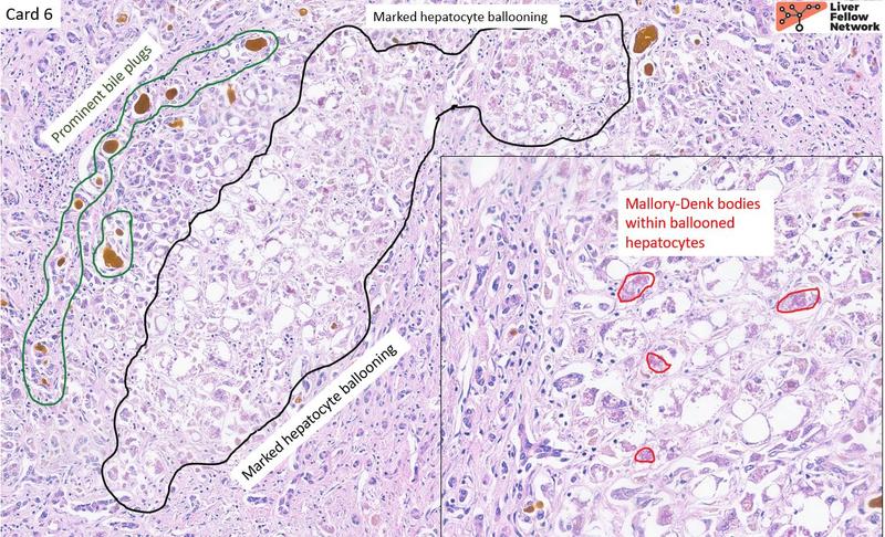 Liver Pathology | AASLD